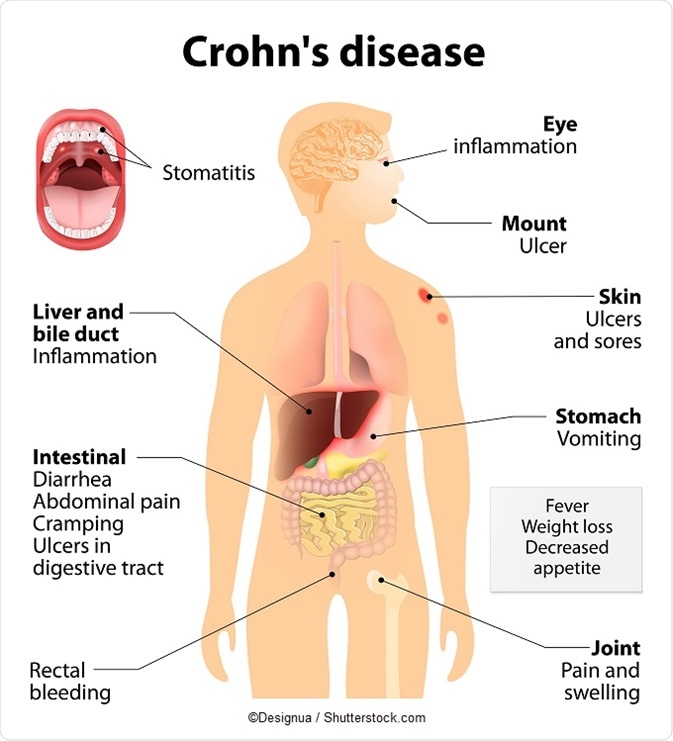 What is Crohn's Disease Treatment